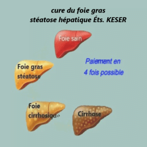 Stéatose hépatique