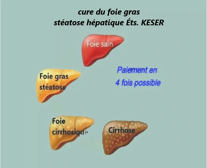 Stéatose hépatique
